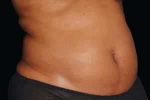 Coolsculpting Abs Before