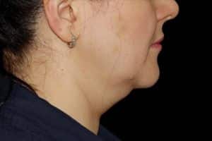 CoolSculpting Chin Before